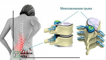 <span>заболевания</span>Грыжа поясничного отдела